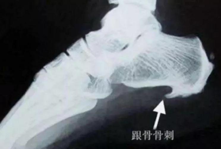 什么“骨刺”竟然是“好”东西?我们一直都“错怪”它了?(图4)