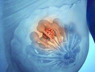 良性肿瘤也要警惕!良性的也会要命!(图3)