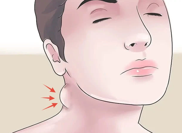 淋巴瘤“青睐”年轻人，这2处“变大”，小心患癌(图3)