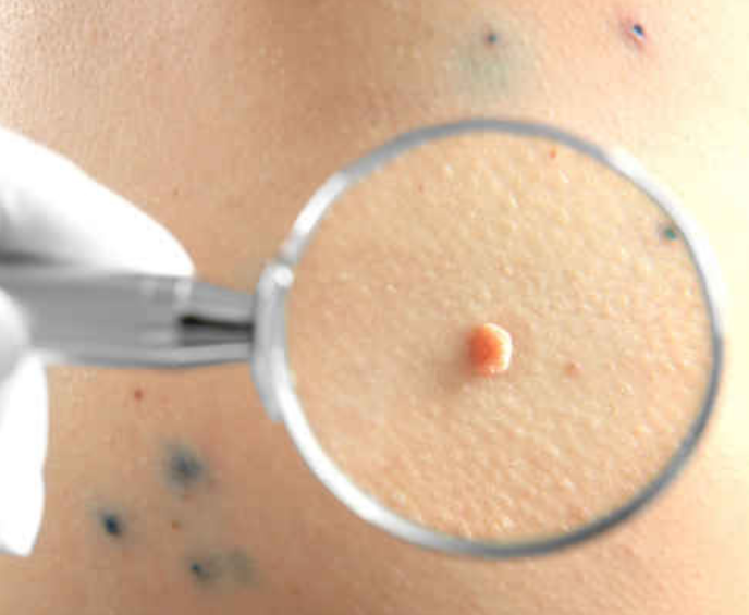 不痛的肿块最可怕!这种小疙瘩可能是癌转移，千万要小心!(图4)