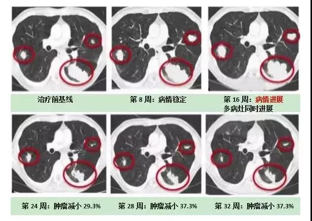 肿瘤增大都可能是骗人的？标志物升高也不一定恶化！(图2)