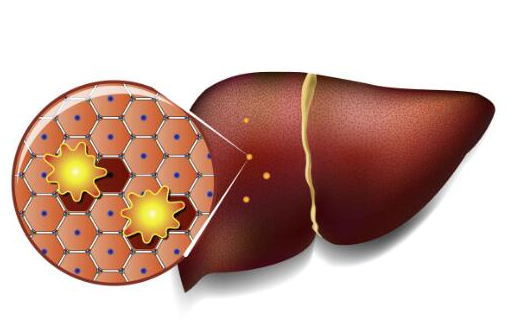 脂肪肝会直接转成肝癌，这三类人要警惕!(图2)