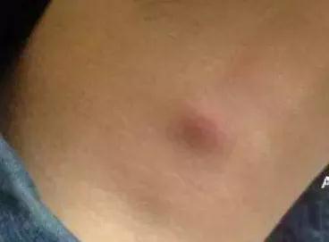 医生提醒：脖子这5个迹象，暗示癌细胞已“苏醒”快看一看(图2)