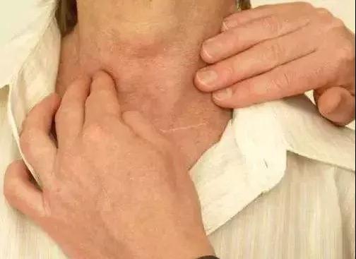 医生提醒：脖子这5个迹象，暗示癌细胞已“苏醒”快看一看(图4)