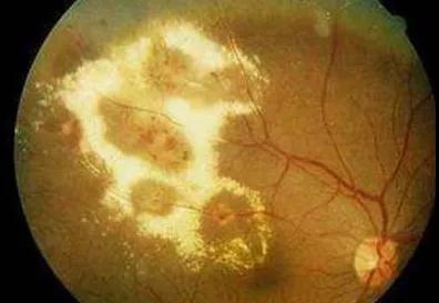 年轻人眼癌增三成! 睡前关灯玩手机会得眼癌?真相是…(图4)