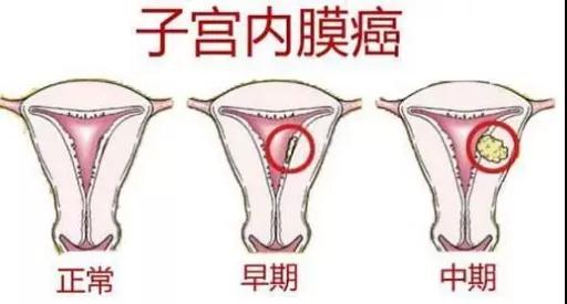 月经失调离子宫内膜癌到底有多远?(图3)