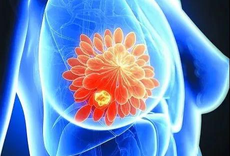 六种癌症会遗传!家里有病史的人，做好2件事，能避开....(图5)