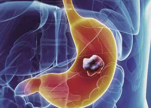 六种癌症会遗传!家里有病史的人，做好2件事，能避开....(图4)