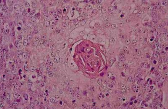 鱼刺扎了一下，5年没好变成癌!赵忠祥就因这种癌去世!(图3)