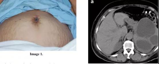 腹腔恶性肿瘤的「信号」：这种脐周结节你见过吗?(图2)