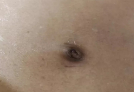 腹腔恶性肿瘤的「信号」：这种脐周结节你见过吗?(图4)