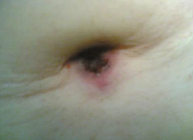 腹腔恶性肿瘤的「信号」：这种脐周结节你见过吗?(图5)