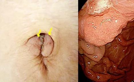 腹腔恶性肿瘤的「信号」：这种脐周结节你见过吗?(图3)