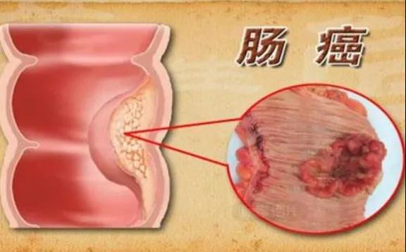 肠息肉开始癌变，大便会有四个标志(图2)