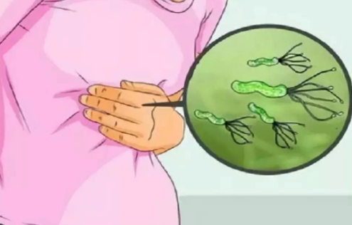 感染幽门螺杆菌，就会得胃癌吗?(图4)