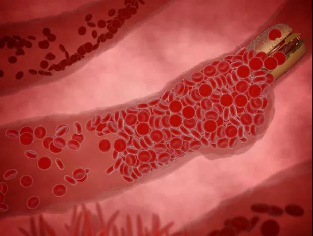 比油和盐还伤血管，世卫组织已呼吁停止食用，劝早日忌口(图1)