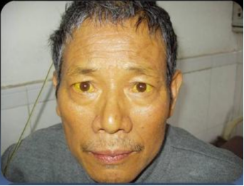 胰腺癌被很多人误诊为胃病!出现这几个症状，要及时就医(图3)