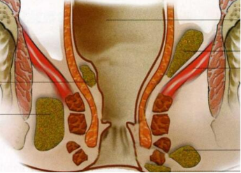 警惕!“肛门息肉”会致癌!与痔疮有什么区别?(图4)