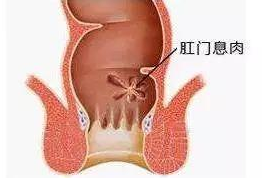 警惕!“肛门息肉”会致癌!与痔疮有什么区别?(图2)