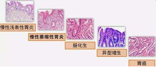 从胃炎到胃癌才5步!警惕癌变过程中的这5个征兆!(图2)