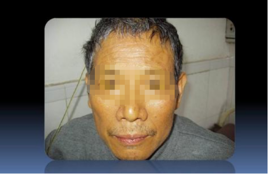 专家提醒：脸上的三种变化，可能与癌症有关，别不当回事!(图2)