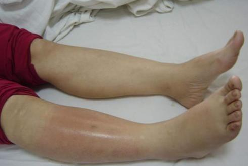 血管堵塞的人，腿上会出现5种表现，占上一个，小心“血栓(图3)