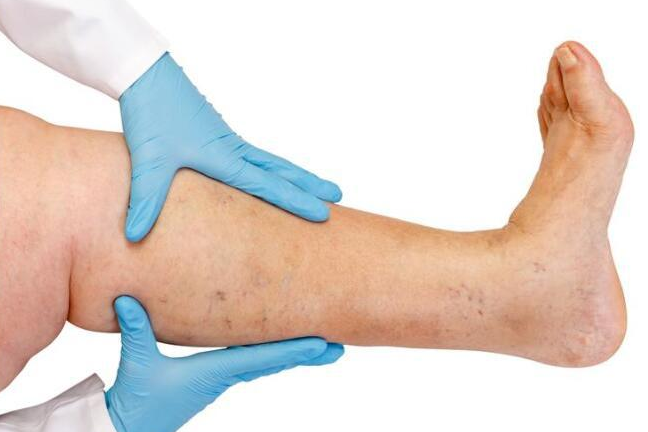 血管堵塞的人，腿上会出现5种表现，占上一个，小心“血栓(图4)