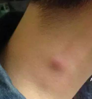 不管男女，脖子上出现这些东西，或许是“癌细胞”在靠近(图4)