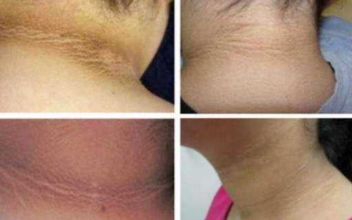 不管男女，脖子上出现这些东西，或许是“癌细胞”在靠近(图2)