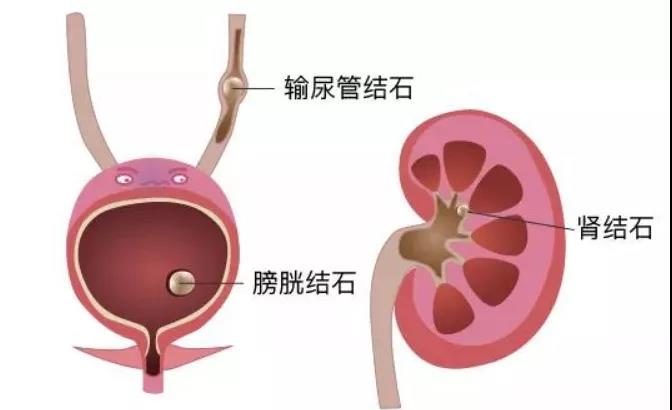 肾结石