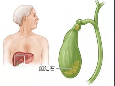 胆结石