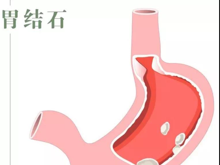 胃结石