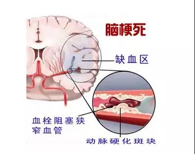 【科普】脑梗：1步自测、3步判断、7步预防(图2)