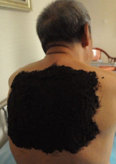 覃氏瑶医涂膏疗法