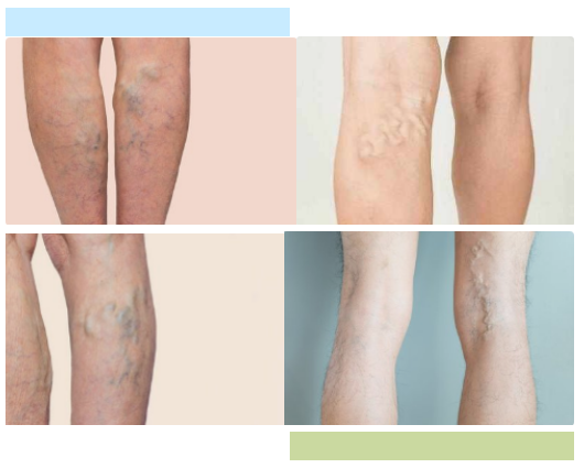 “穿筋走脉法”治疗下肢静脉曲张效果“的确好”！(图2)