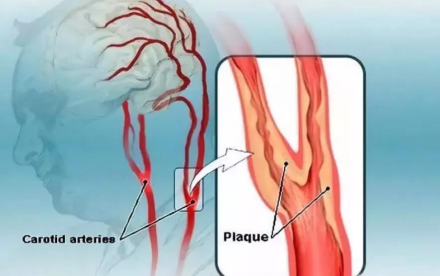 这根血管很怕堵，2个病变要点需注意，不妨​给血管..(图2)