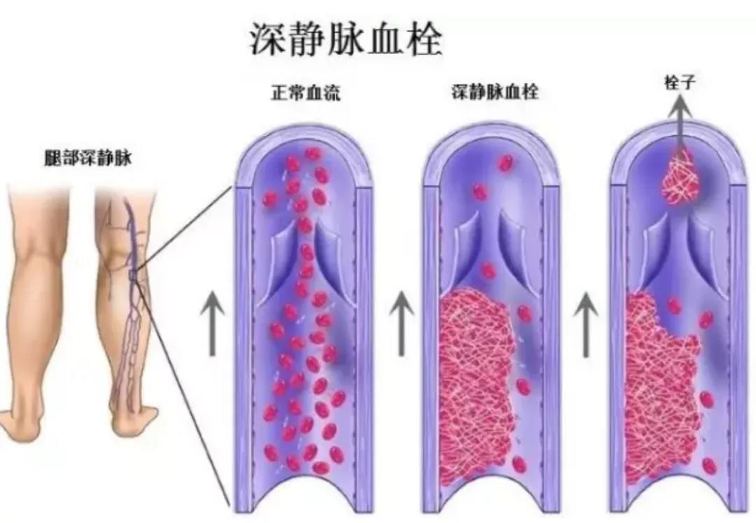 这里的血栓最致命，80%发病前无症状，早预防早远离(图3)