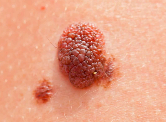 皮肤异常,或是癌症的征兆,这5个改变可能是癌症的信号(图2)