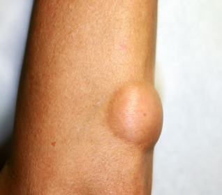 脂肪瘤严不严重?危害大不大，还得看这些!(图3)