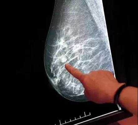 这4种“长相”的乳腺结节，警惕是恶性肿瘤!太多女生吃过亏(图2)