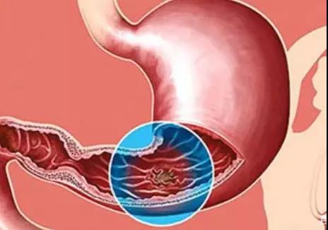 出现这2个信号，是胃溃疡癌变了！(图2)