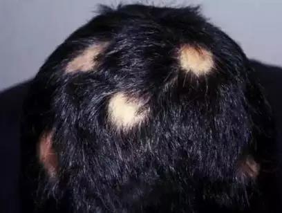 扎心！脱发增加癌症风险？(图3)