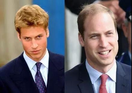 扎心！脱发增加癌症风险？(图2)