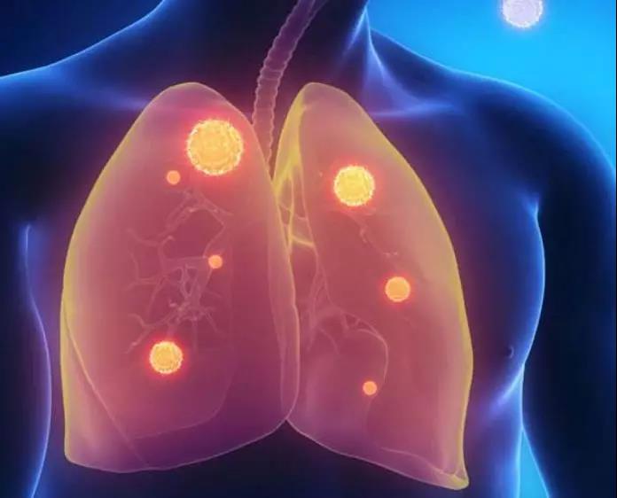 城市白领女性更容易患肺磨玻璃结节,它才是引发肺肿瘤..(图3)