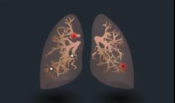 城市白领女性更容易患肺磨玻璃结节,它才是引发肺肿瘤..(图2)