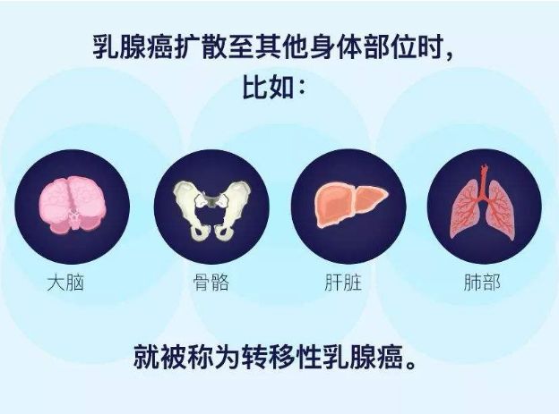 乳腺肿瘤最易出现肺转移，出现这些症状一定要警惕!(图3)