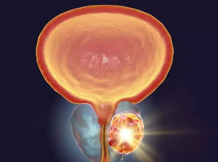 如何分辨前列腺增生和前列腺肿瘤?这四条可以做到..(图3)