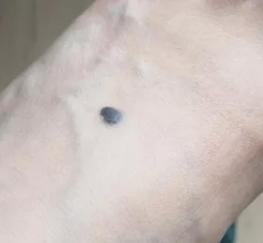 医生看了一眼这个“痣”，就说是肝癌信号?这25种痣也是...(图18)