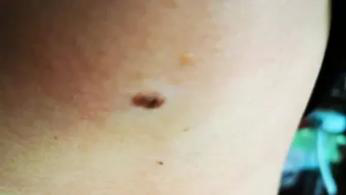 医生看了一眼这个“痣”，就说是肝癌信号?这25种痣也是...(图20)