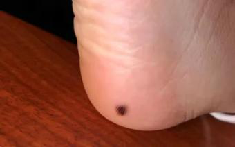 医生看了一眼这个“痣”，就说是肝癌信号?这25种痣也是...(图22)